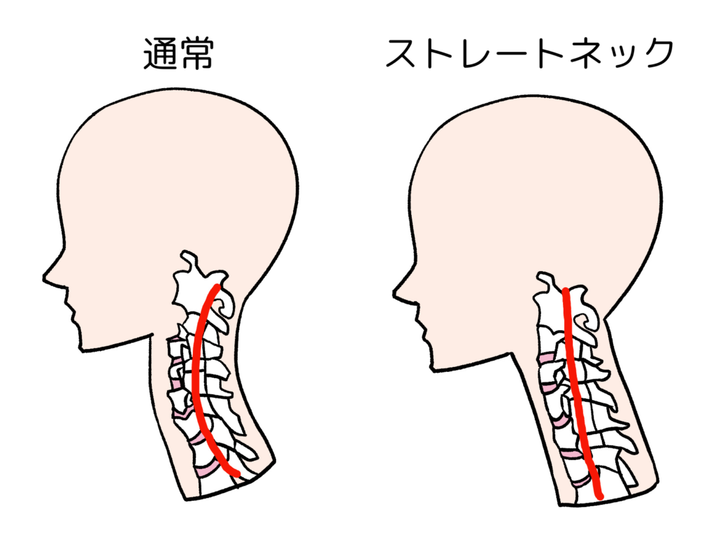 ストレートネックと通常の首の違い