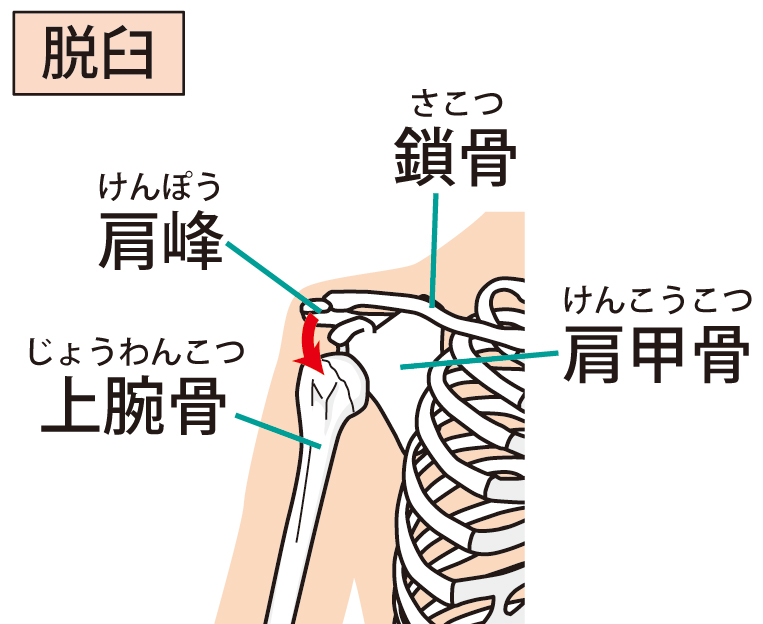 肩関節脱臼