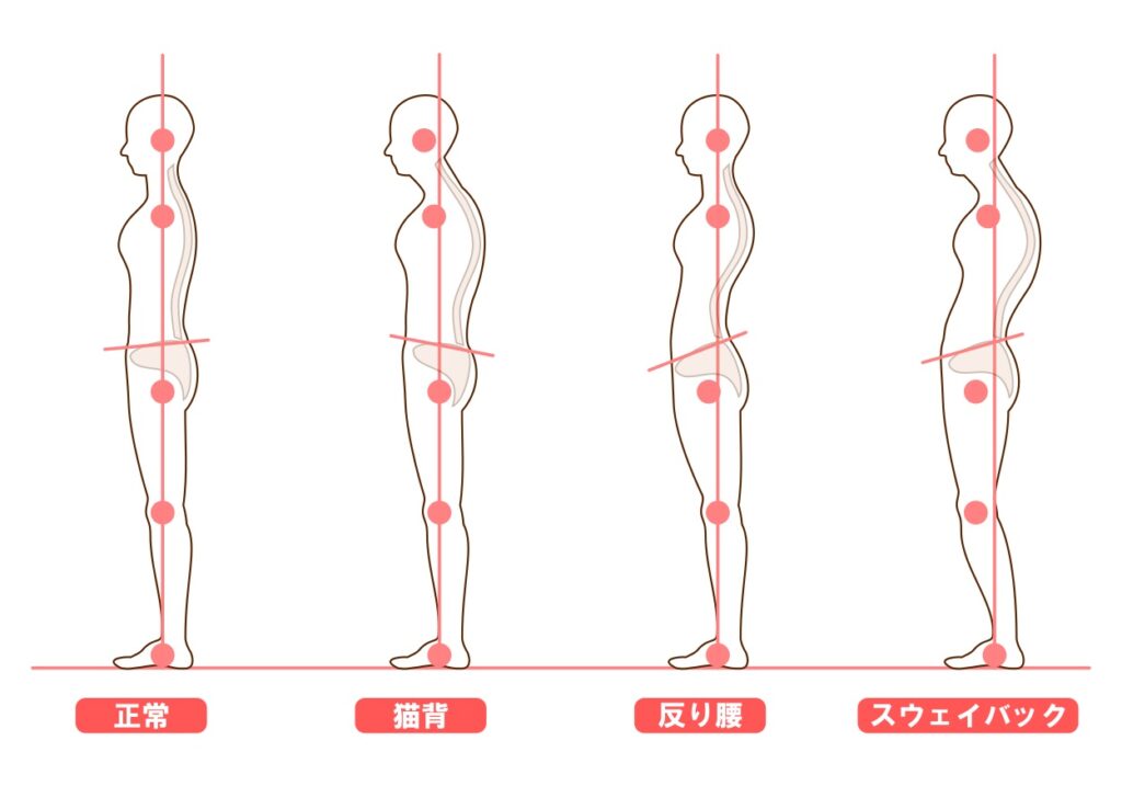 猫背のタイプがわかるイラスト