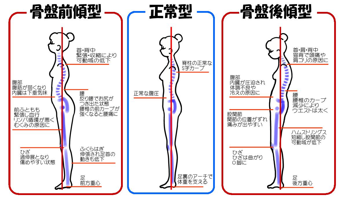 猫背のタイプ別解説のイラスト