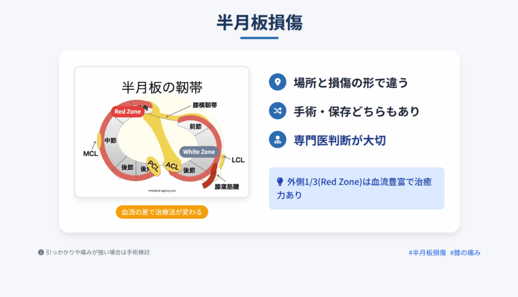 半月板損傷の治療方針を解説するインフォグラフィック。半月板の解剖図(Red Zone/White Zone)と共に、「場所と損傷の形で違う」「手術・保存どちらもあり」「専門医判断が大切」といったポイントが示されている。