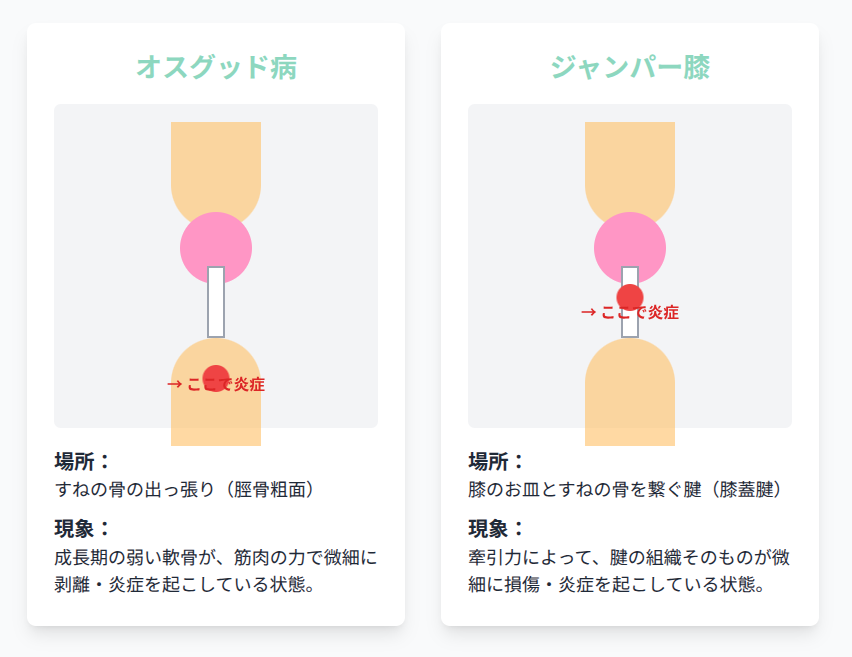 オスグッド病とジャンパー膝の違いを比較する図解。オスグッド病が脛骨粗面の剥離であるのに対し、ジャンパー膝は膝蓋腱の炎症であることを、シンプルなイラストで視覚的に解説している。